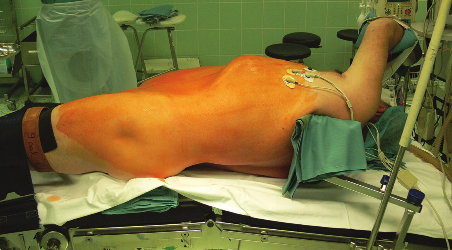 Poloha nemocného
Fig. 1: Position of the patient