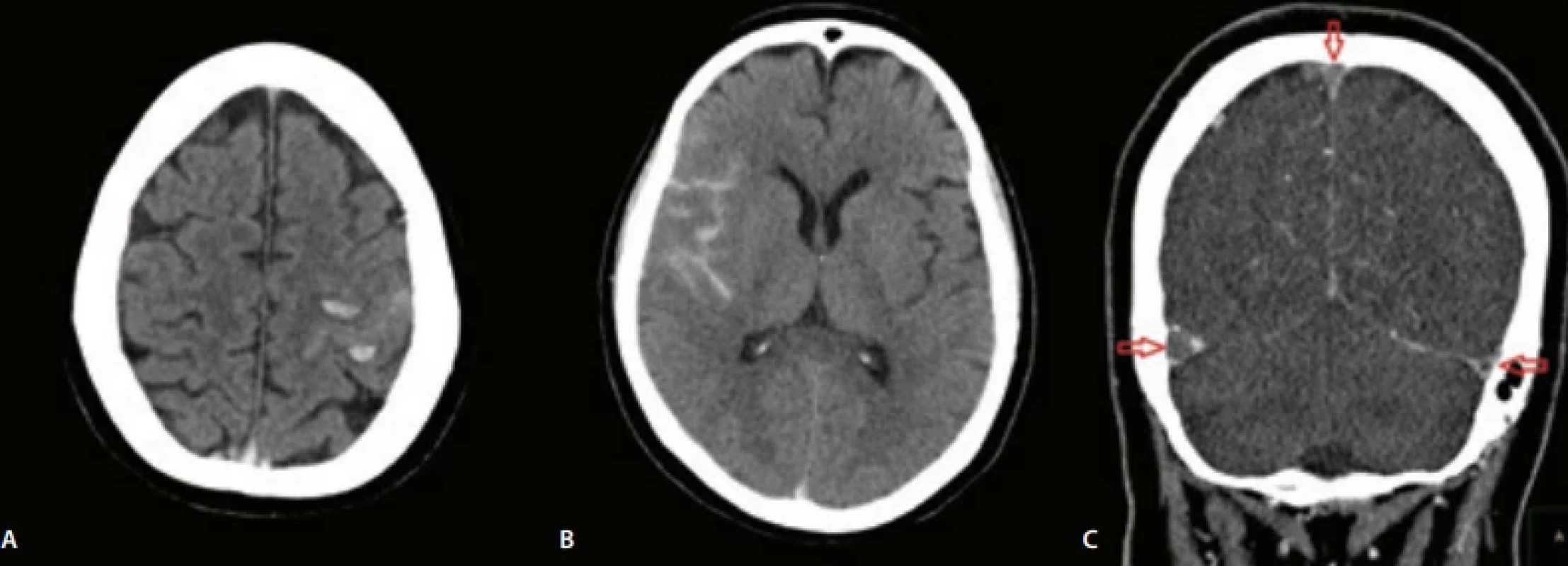 Vstupní CT – intracerebrální hemoragie (A), subarachnoidální hemoragie (B) a trombóza splavů (C).