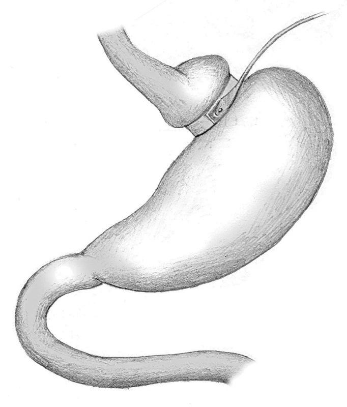 Adjustabilní bandáž žaludku
Fig. 1: Adjustable gastric band