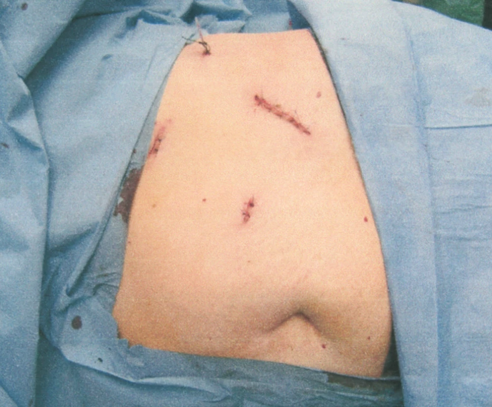 Fotografie stěny břišní po levostranné adrenalektomii. Extrahován karcinom kůry o průměru 10,1 cm. Viz obr. 3 a 6
Fig. 4. View of the abdominal wall following adrenalectomy on the left. Acortical carcinoma, measuring 10.1 cm in a diameter, was removed. see Fig. 3 and 6