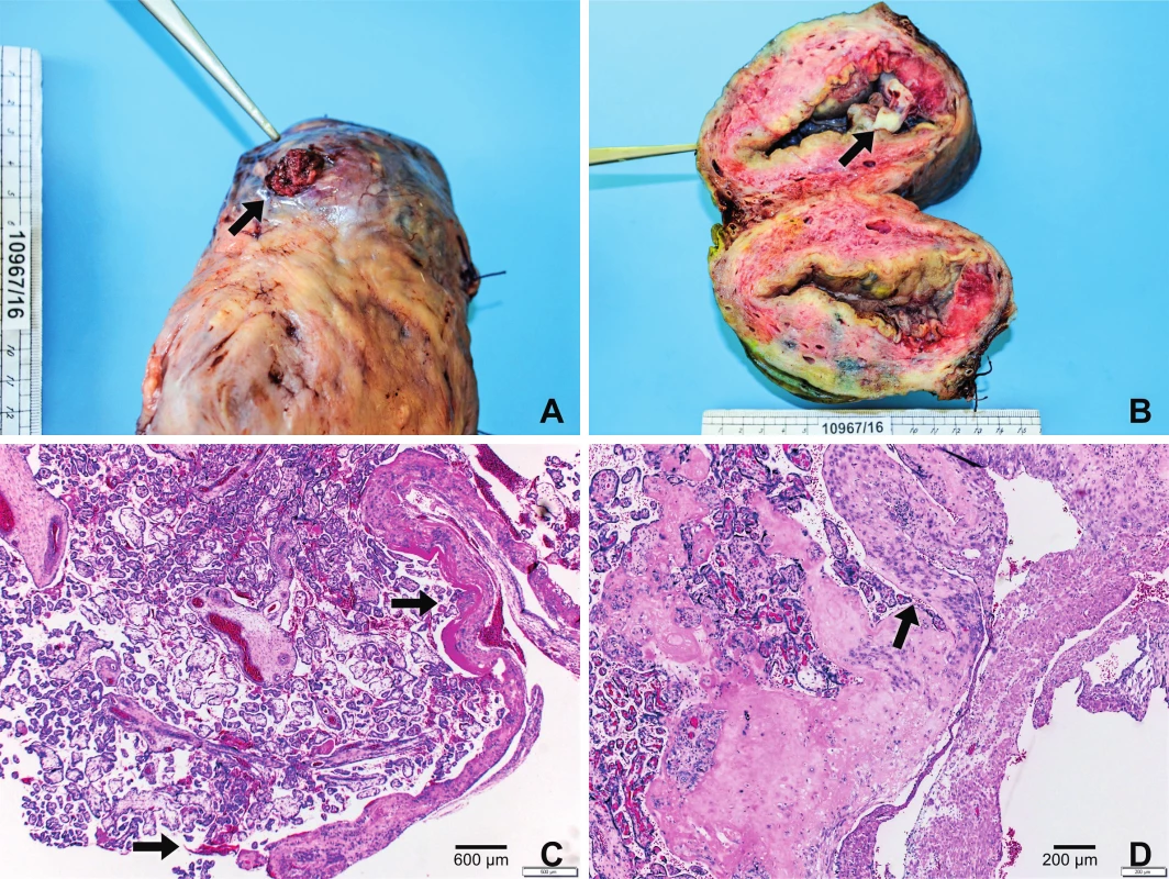 Histopatologické vyšetření
A. Placenta percreta prorůstající levým rohem děložním
B. Průřez dělohou v místě perkrétní placenty
C. V preparátu z místa popsaného defektu ve fundu jsou struktury placenty prorůstající zčásti do subserózního vaziva a poté volně přecházející na povrch, barvení HE, zvětšení 100x
D. Průřez děložní stěnou s překrvenými placentárními klky do zevní části myometria a subserózního vaziva, barvení HE, zvětšení 100