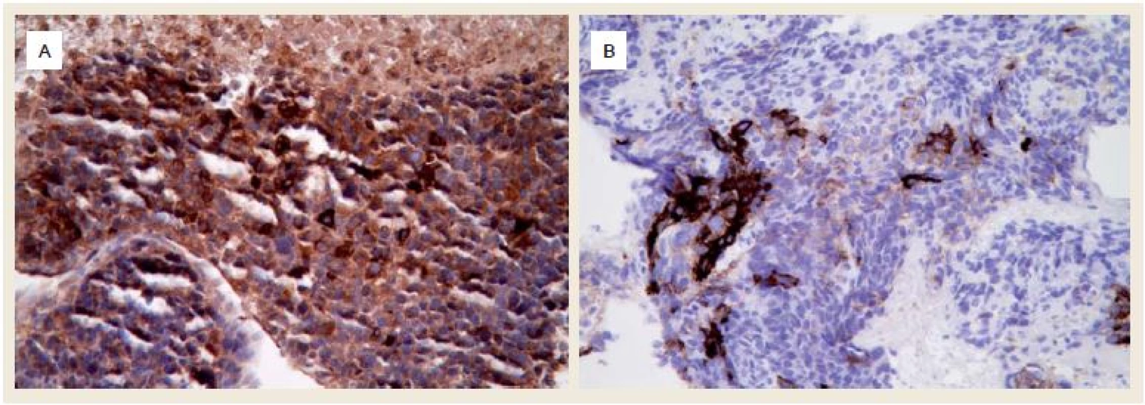 A. Silná exprese α-fetoproteinu v nádorových buňkách (imunohistochemie, původní zvětšení 400×),  B. Fokální silná exprese glypicanu-3 (imunohistochemie, původní zvětšení 400×).
Fig. 4. A. Strong expression of α-fetoprotein in tumour cells (immunohistochemistry, original magnification ×400),  B. Focal strong expression of glypican-3 (immunohistochemistry, original magnification ×400).