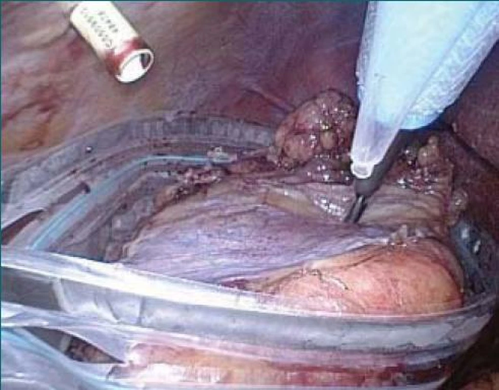 Uložení preparátu do sáčku EndoCatch®.