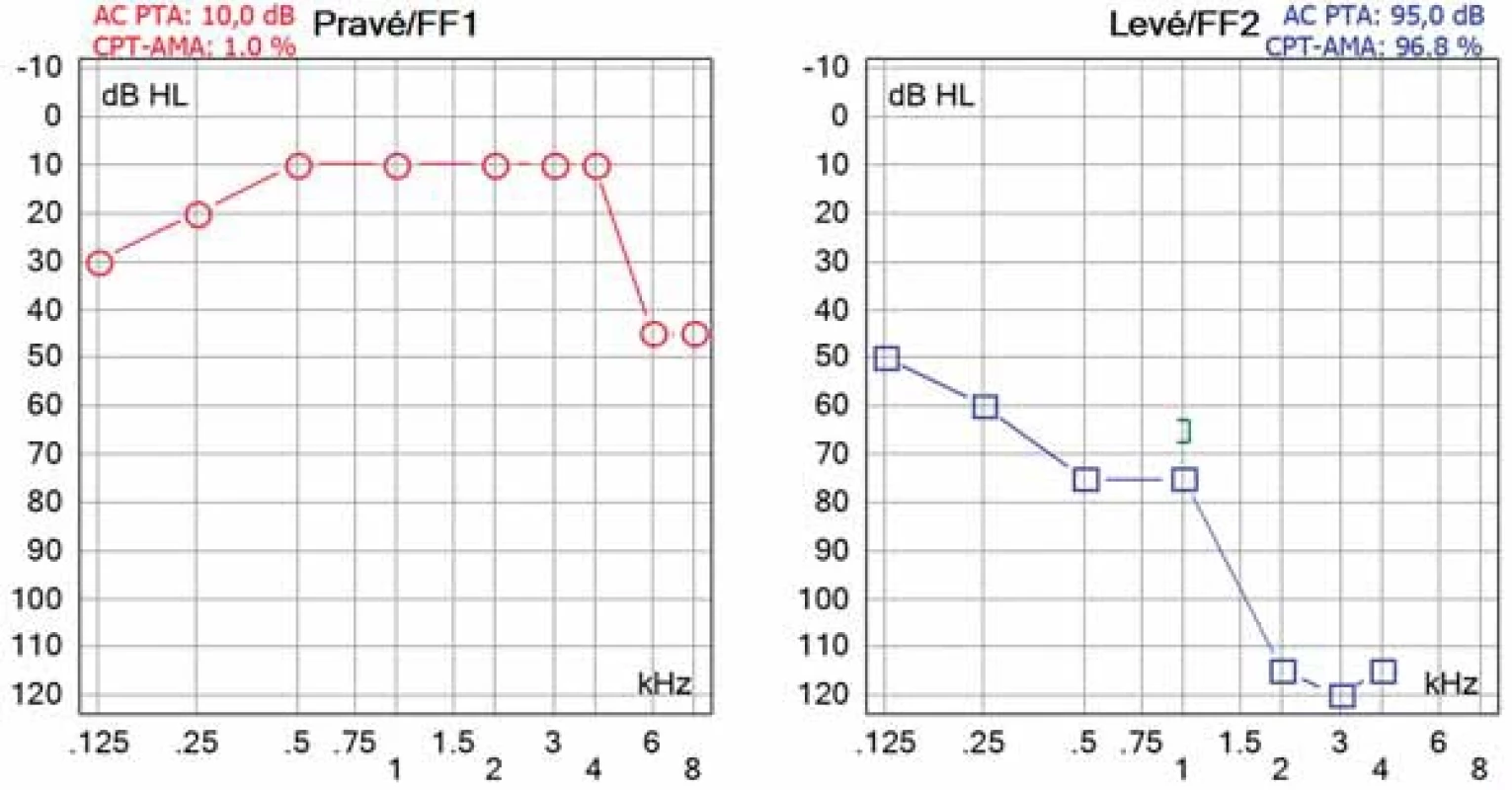 Prahový tónový audiogram 4 měsíce od stanovení diagnózy s parciálním zlepšením sluchu.