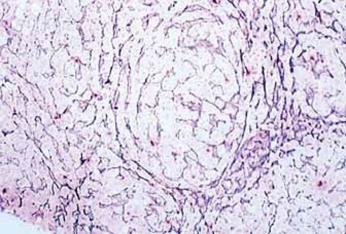 Histologické vyšetření necílené jaterní biopsie. Barvení na retikulin. Zvětšeno 400×.