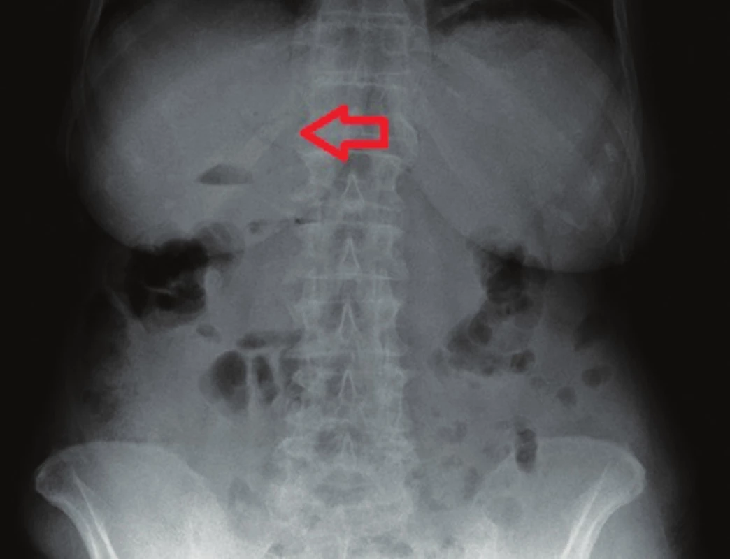 RTG břicha – gastrektázie a diskrétní pneumobilie (šipka)
Fig. 1: AXR – gastrectasis and discrete pneumobilia (arrow)
