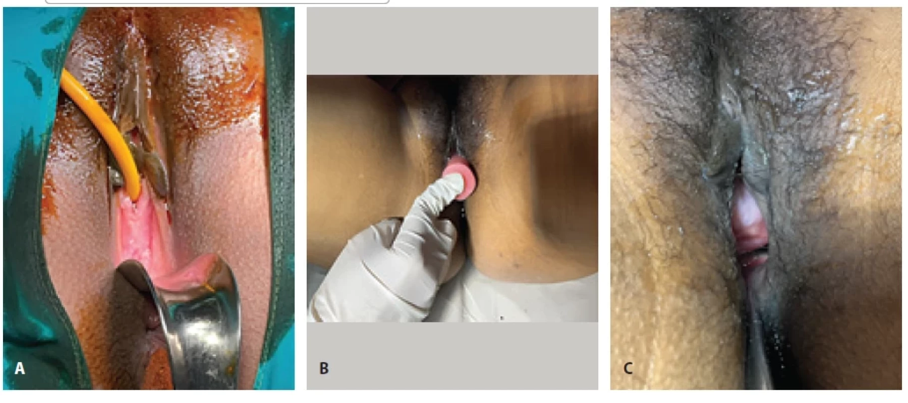 A) MRKH type 1: pre-operative image showing no vaginal opening; B) post-operative image showing reconstructed vagina with adequate dilatation; C) late post-operative image.