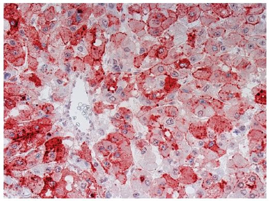 Hepatocelulární karcinom s nepárovou artérií a pozitivním imunohistochemickým průkazem glypicanu-3 (anti-Glypican-3, clone 1G12, Santa Cruz Biotechnology CA, USA; detekce Histofinem a červenou koncovkou s 3-amino-9-ethylcarbazolem). Zastižena je membránová a cytoplazmatická pozitivita. Zvětšení, objektiv 40x.
