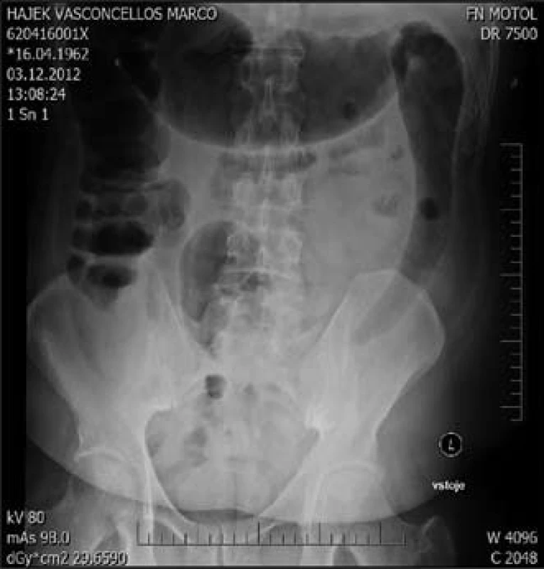 Nativní snímek břicha ve­stoje – megakolon.
Fig. 5. Megacolon (X-rays image).
