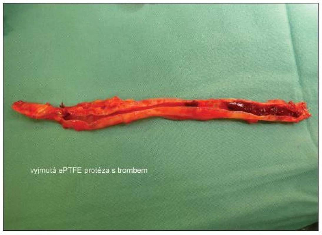 Vyjmutá ePTFE protéza s trombem
Fig. 3. Removed ePTFE prosthesis with thrombus