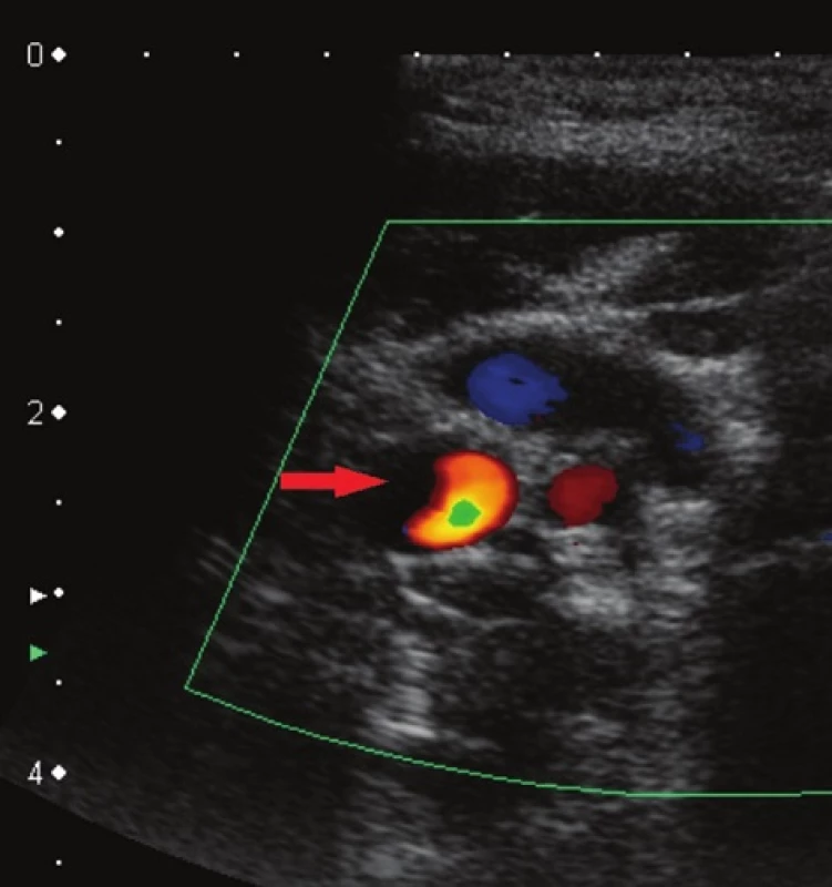 Sonografický obraz po rozpuštění trombu – karotida bez trombu
Fig. 6: Sonography finding after dissolution of the thrombus – carotid artery without thrombus