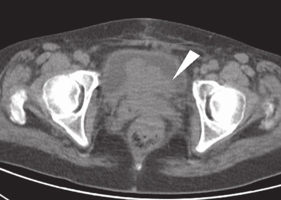 CT vyšetření: rozsáhlý tumor malé pánve, postihující rektum, pochvu a močový měchýř – indikace k totální pelvické exenteraci (bílá šipka).
Fig. 1: CT: large tumour of the small pelvis, invading the rectum, vagina and urinary bladder – indication for total pelvic exenteration (white arrow).