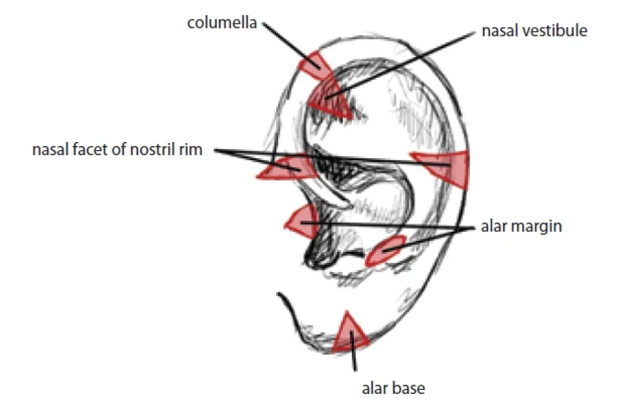 Locations of harvesting composite chondrocutaneous grafts for individual parts of the nose. (Drawing by A. Berkeš according to [70]).