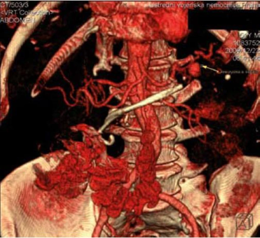 Cevní rekonstrukce s jasně patrným pseudoaneurysmatem lienální arterie o průměru 16 mm. Stenty v ductus Wirsungi před aortou.
Fig. 1. Vascular reconstruction – splenic artery pseudoaneurysm – diameter 16 mm. A pancreatic duct stent in front of the aorta.