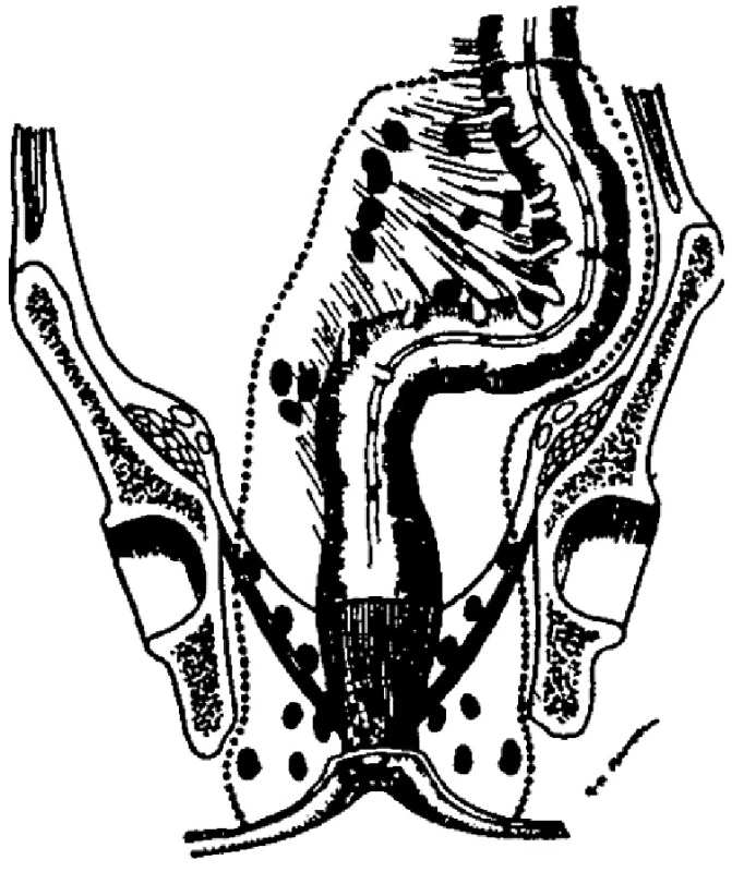 Schéma rozsahu operace
Fig. 2. Figure showing the extent of rectal excision