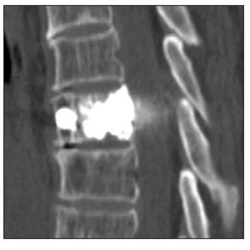 CT hrudní páteře, sagitální rekonstrukce po vertebroplastice obratle Th7
Fig. 4. Thoracic spine CT, sagittal reconstruction following TH7 vertebroplasty