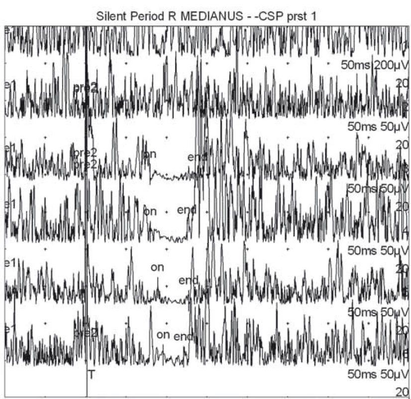 Příklad normální kožní periody útlumu snímané z m. APB po bolestivé stimulaci 1., 3. a 2 × 5. prstu (první dvě horní křivky jsou vizualizací svalové síly bez aplikace bolestivých stimulů).
Fig. 1. Example of normal cutaneous silent period recorded from m. APB after painful stimulation of the 1<sup>st</sup>, 3<sup>rd</sup> and 5<sup>th</sup> finger × 2 (the first two upper curves represent visualization of muscle strength without application of painful stimuli).