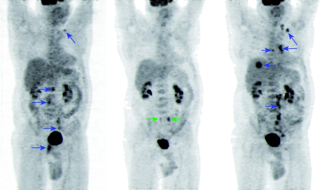 18F-FDG PET sken, MIP (maximum intensity projections).
A. před zahájením léčby, B. v jejím průběhu, C. při progresi onemocnění.
A. Ložiska vyšší konzumpce glukózy (modré šipky) v levém nadklíčku, retroperitoneálních uzlinách, ilických uzlinách vlevo a v pánvi retrovesikálně odpovídající primárně tumoru rekta.
B. Vymizení výše popsaných ložisek hypermetabolizmu glukózy, tj. dosažení PET kompletní remise, po 4 sériích léčby. Oboustranně zachycena vřeténka aktivní moči v ureterech – odpovídající vylučování radiofarmaka močí (zelené šipky). C. Znovu se zobrazují ložiska patologického hypermetabolizmu glukózy (modré šipky) po 13 měsících od zahájení léčby, a to ve více uzlinách levého nadklíčku, v mediastinu a levém plicním hilu, seg. VIII. pravého laloku jater a ve více uzlinách retroperitone a vlevo a levostranných ilických uzlinách.