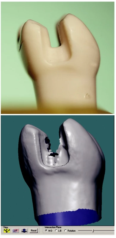 a) Zub 36 - MD pohled.
b) Artefakt - roztřepení okraje.