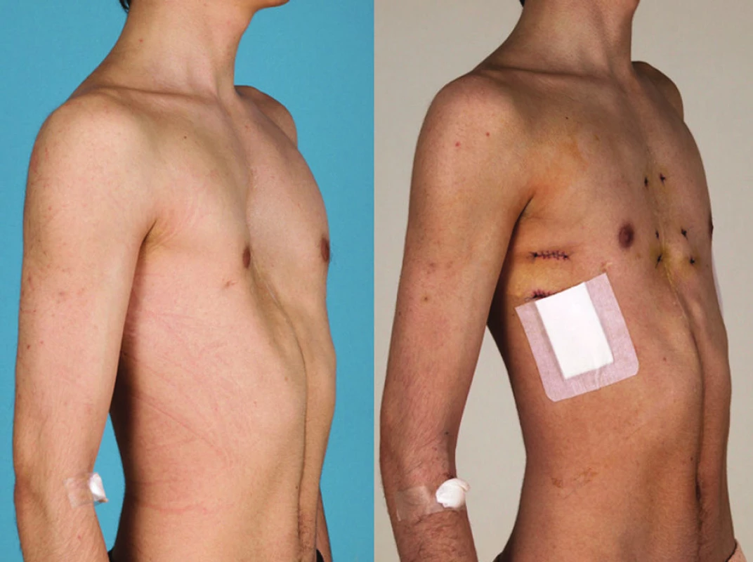 Předoperační a pooperační stav u pacienta operovaného Nussovou metodou s pomocnými sternotomiemi pro recidivu PE po otevřené sternochondroplastice
Fig. 5: Pre and postooperative view of the patient after open sternochondroplasty, who underwent Nuss procedure with transversal sternotomies for relapsing PE