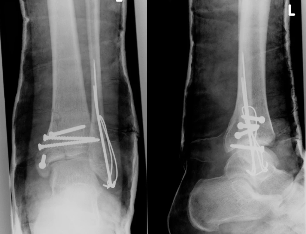 Miniosteosyntéza a sádrová imobilizace
Fig. 11: Miniosteosynthesis and cast immobilisation