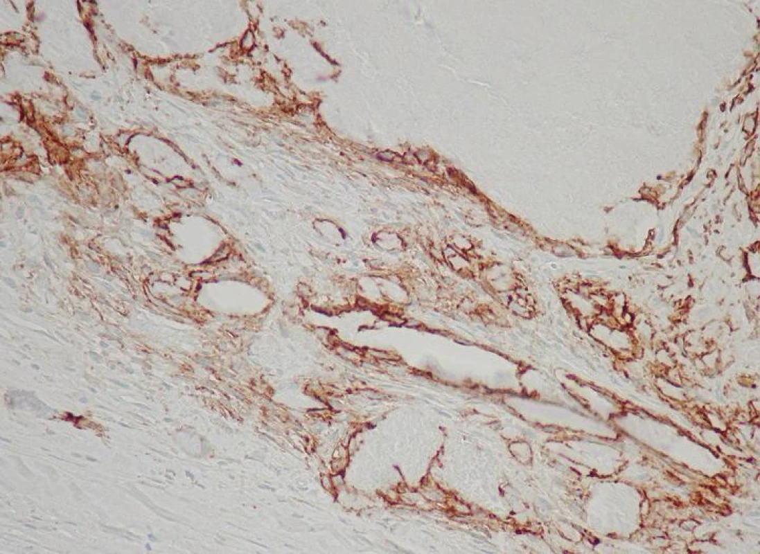 D2-40+ lymphatics