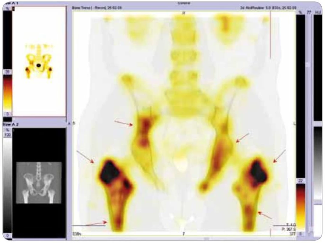 Scintigrafie skeletu: podrobnější zobrazení pánve metodou SPECT . Jsou zřetelná ložiska se zvýšenou aktivitou radiofarmaka.