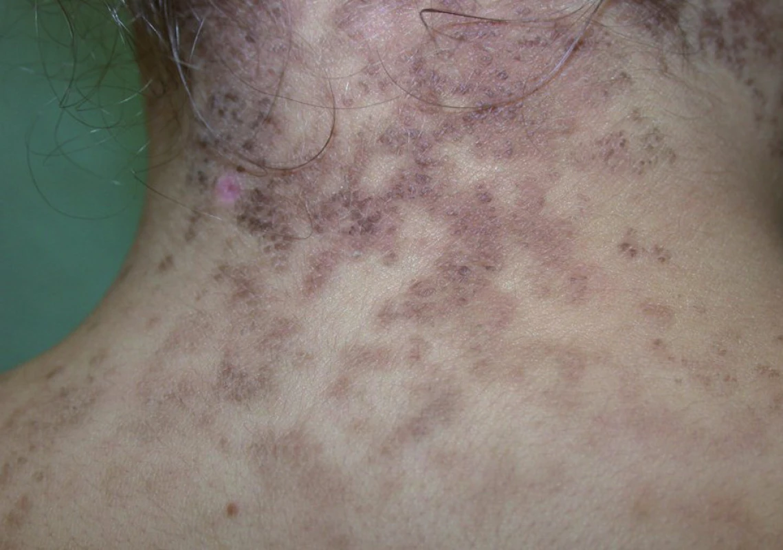 Klinický obraz pacientky – případ 3.