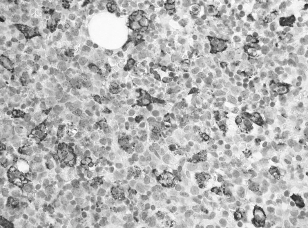 Prvé trepanobioptické vyšetrenie: výrazná hemofagocytóza v makrofágoch drene označených imunohistochemickou reakciou na dôkaz CD68 (60x).
Fig. 2. First trepanobioptic examination: a marked hemophagocytosis in macrophages of bone marrow marked by immunohistochemical reaction for the demonstration of CD68 (60x).