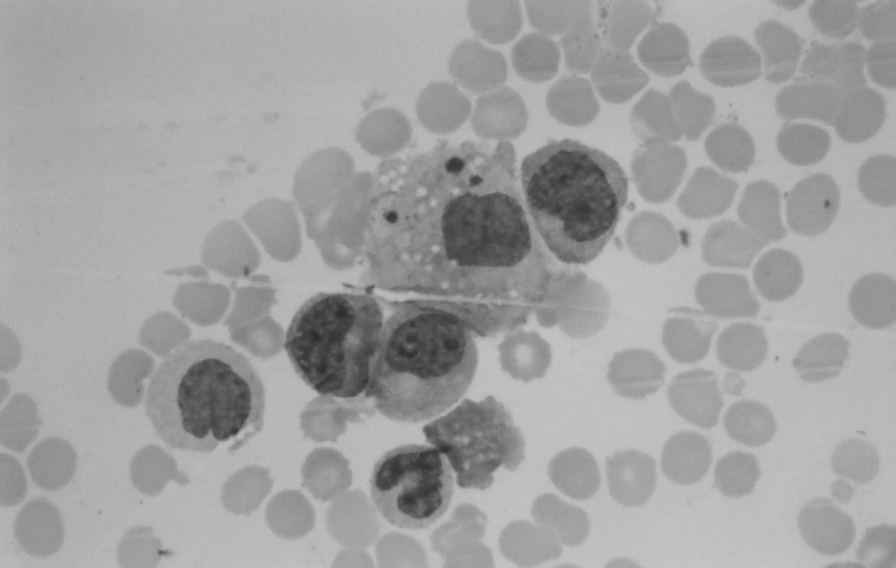 Punkcia kostnej drene: makrofág s fagocytovanými trombocytmi.
Fig. 3. Puncture of bone marrow: macrophage with phagocytosis of thrombocytes.