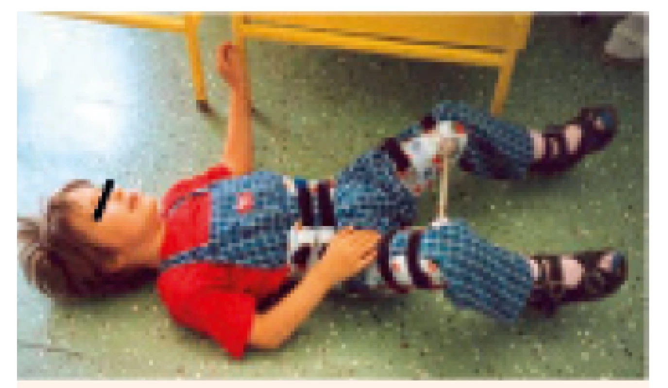 Pacient s nasazenou abdukční pomůckou (Atlanta dlaha).
Fig. 4. Patient using an abduction splint (Atlanta splint).