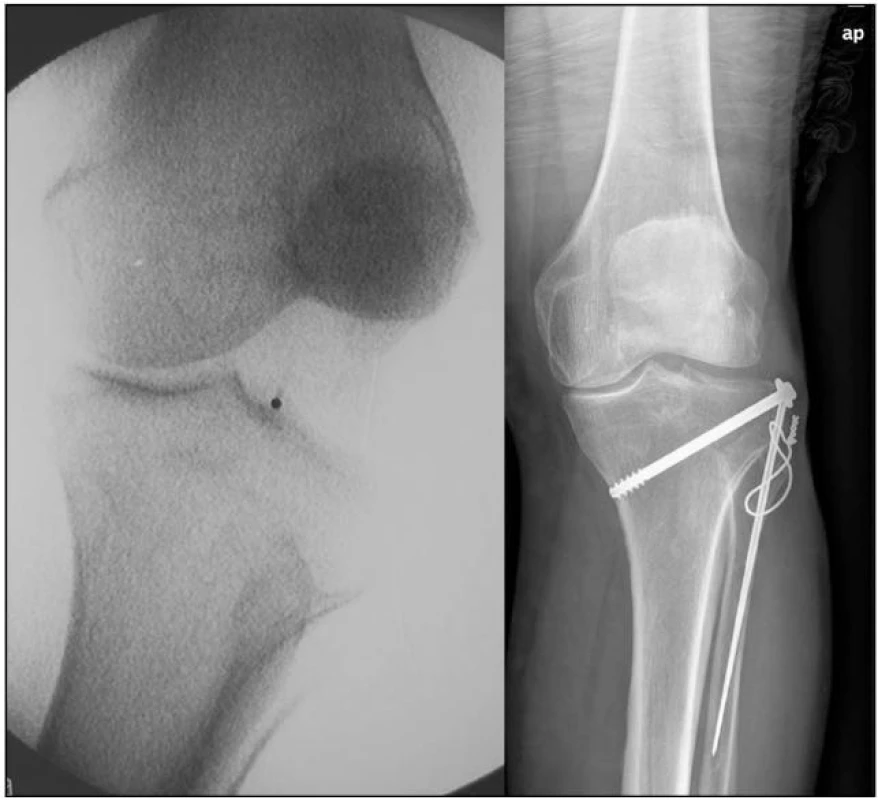 (a) Držený snímek - přítomost abrupce fibuly, tuberculum Gerdi, Segond. zlomenina a ruptura PZV (b)
Stav po osteosyntéze