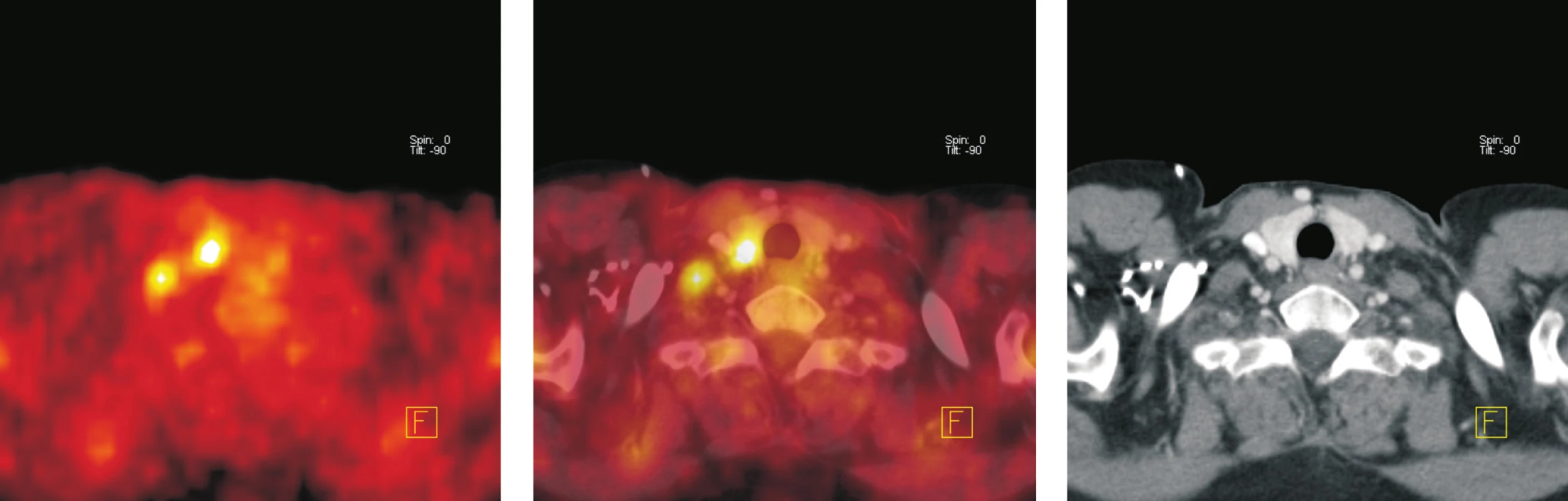 Transverzální tomografické řezy v úrovni štítné žlázy (a - PET, b - fúze PET/CT, c – CT). Ložisko zvýšené akumulace <sup>18</sup>F-FDG v pravém laloku štítné žlázy velikosti 10 x 10 mm, na CT má nehomogenní strukturu. Opakovanou aspirační cytologií, laboratorním vyšetření, klinickým a ultrazvukovým sledováním prokázána koloidní struma bez poruchy funkce. Při kontrolním vyšetření o 12 měsíců později nebyla zvýšená akumulace <sup>18</sup>F-FDG patrná.
