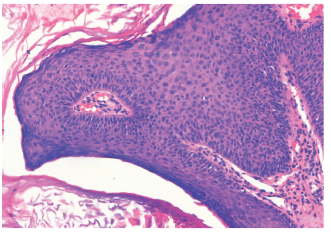 Histologický nález z lézie (HE 100x)
Priečny prierez vulgárnej veruky histomorfologicky pripomínajúcej kožný papilóm s hyperplastickým pravidelným dlaždicovým epitelom s hyperkeratózou s parakeratózou. V stróme je vyznačená papilomatóza mierneho stupňa s lymfocytovou infiltráciou, najmä perivaskulárne.