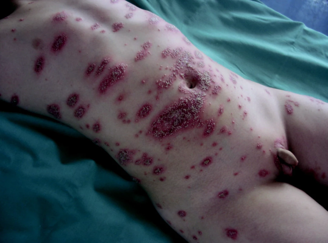 Pustulózní psoriáza.
Fig. 4. Pustulous psoriasis.