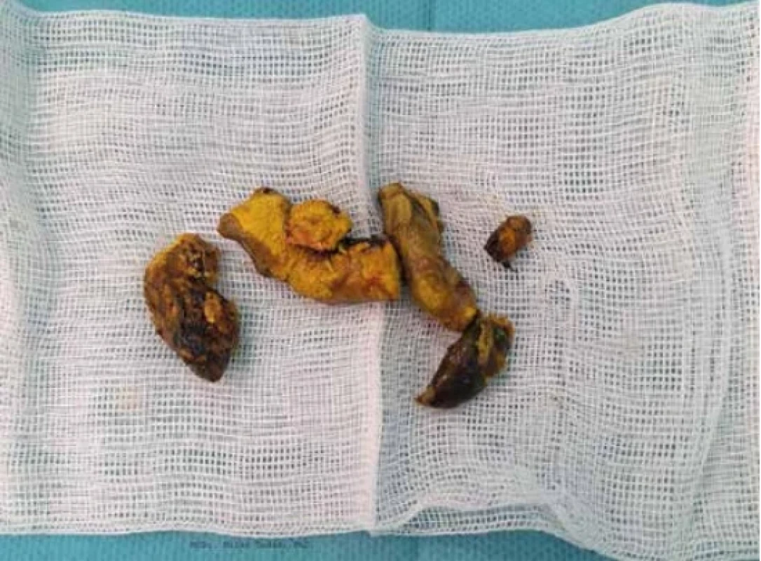 Perioperačný nález, laktobezoár