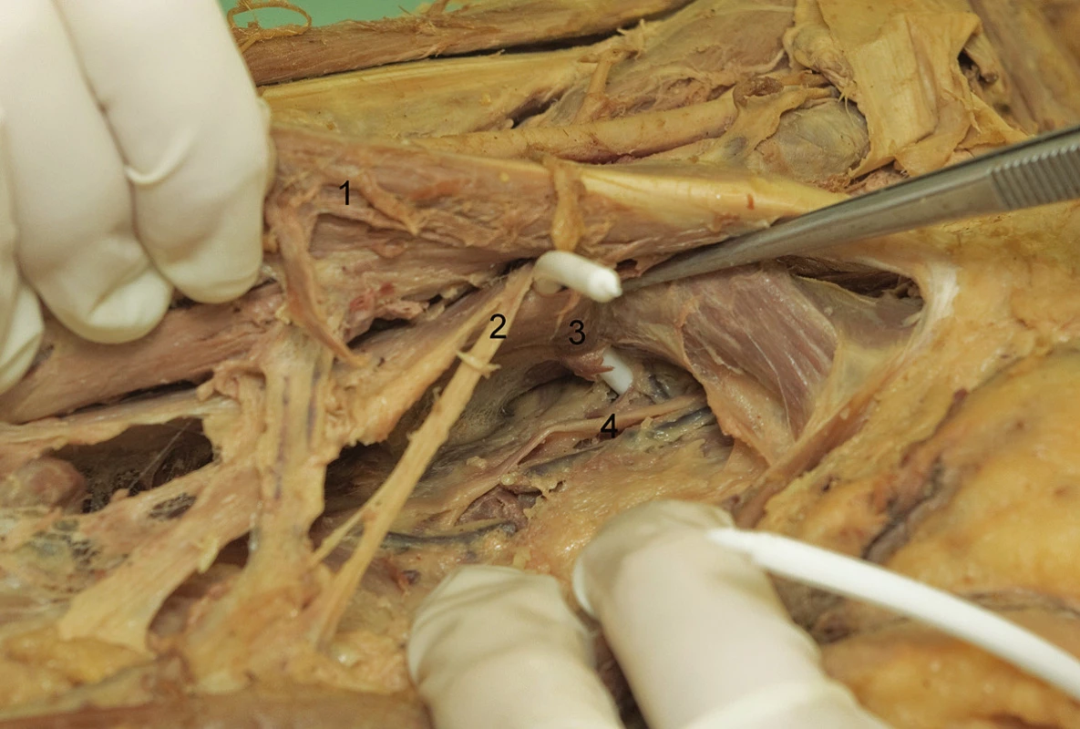 Blízký vztah větví nervus obturatorius k zavaděči TVT-O
1 musculus adductor longus; 2 ramus anterior nervi obturatorii;
3 musculus adductor brevis; 4 ramus posteriori nervi obturatorii