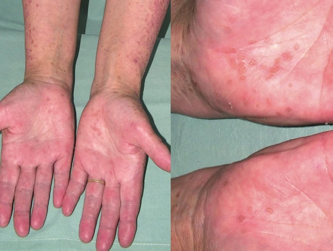 Porokeratosis punctata palmaris et plantaris disseminata