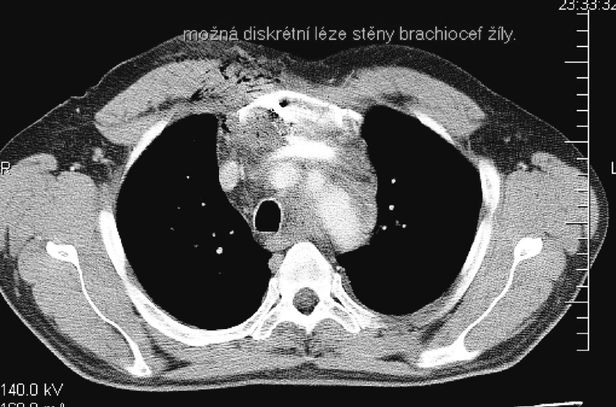 CT nález – Poranenie steny brachiocephalickej žily
Pic. 2. CT finding – Traumatized brachiocephalic venous wall