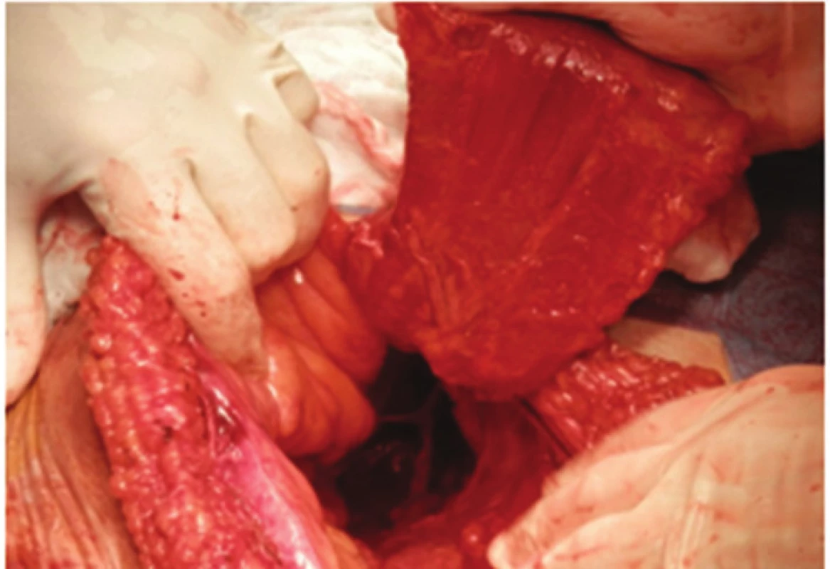 Svalový lalok před uložením do pánve
Fig. 6: Muscle flap before positioning into the pelvis