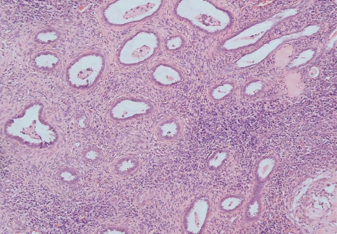 Chronické zánětlivé změny. Barvení: hematoxylin-eozin, zvětšeno 100×.