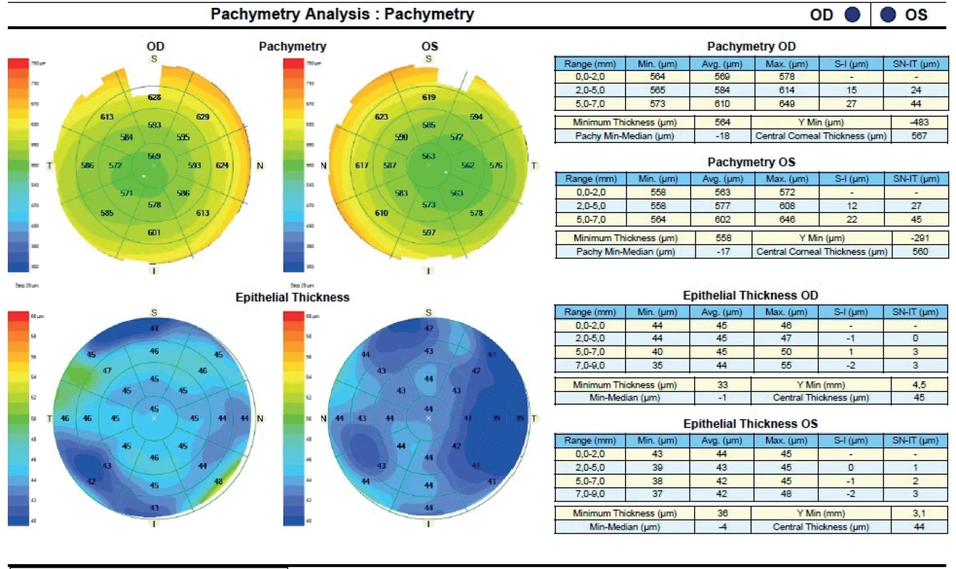 OCT Pachymetry of corneal astigmatism. Note the relatively homonymous distribution of corneal epithelial thickness