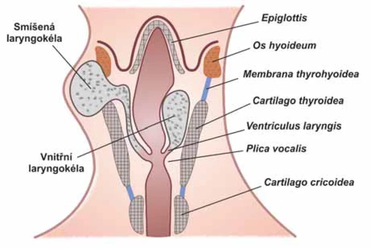 Anatomické schéma hrtanu s vyznačením vnitřní a smíšené laryngokély.
