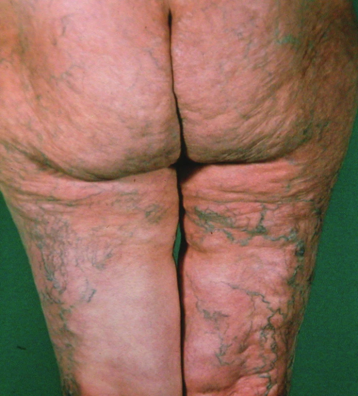 Acrodermatitis chronica atrophicans – hýždě