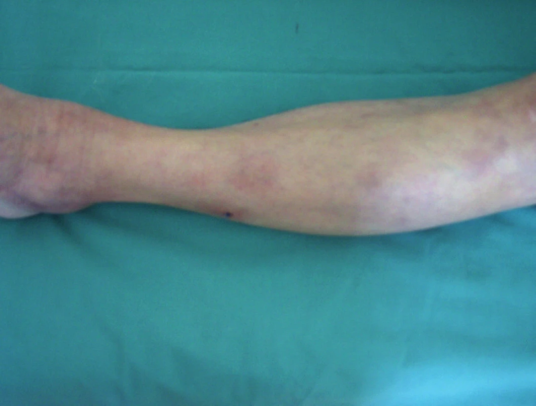 Metastatická varianta Crohnovy choroby klinického obrazu erythema nodosum.