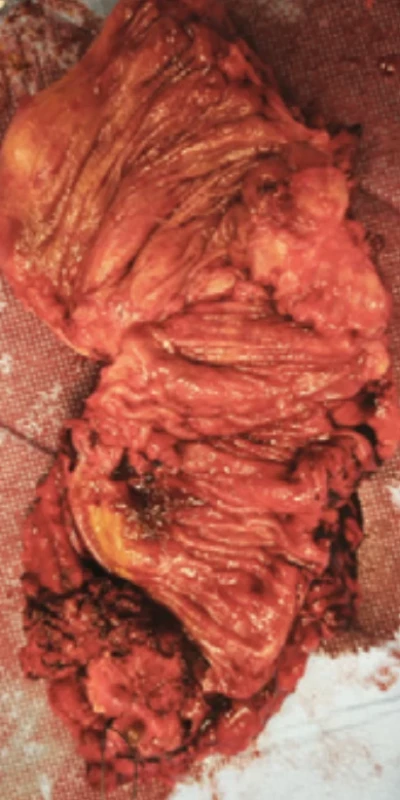Specimen of the rectosigma, in upper part with stenosis, lower part nodule of the rectum with vagina. Obr. 5. Resekát rekrosigmatu, v horní části stenotizující ložisko na sigmatu, v dolní části rektální uzel s částí pochvy