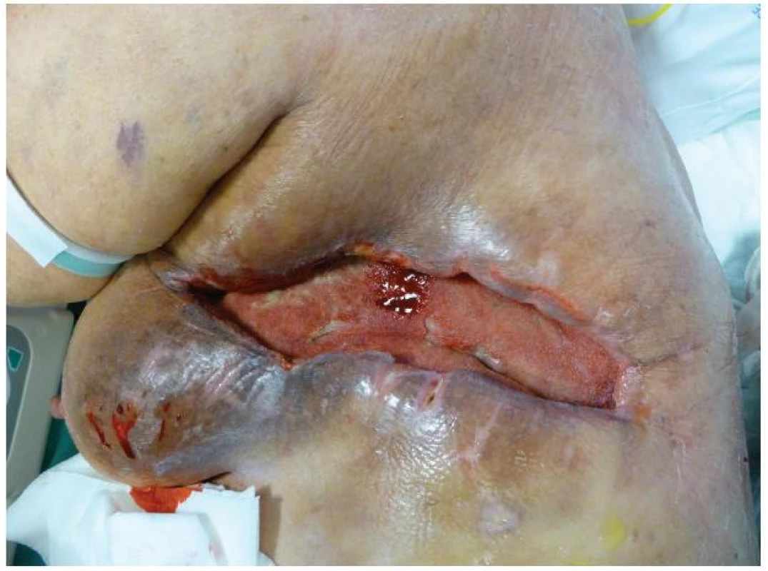 Stav rány po 6 týdnech podtlakové terapie
Fig. 5: The condition of the wound after 6 weeks of NPWT