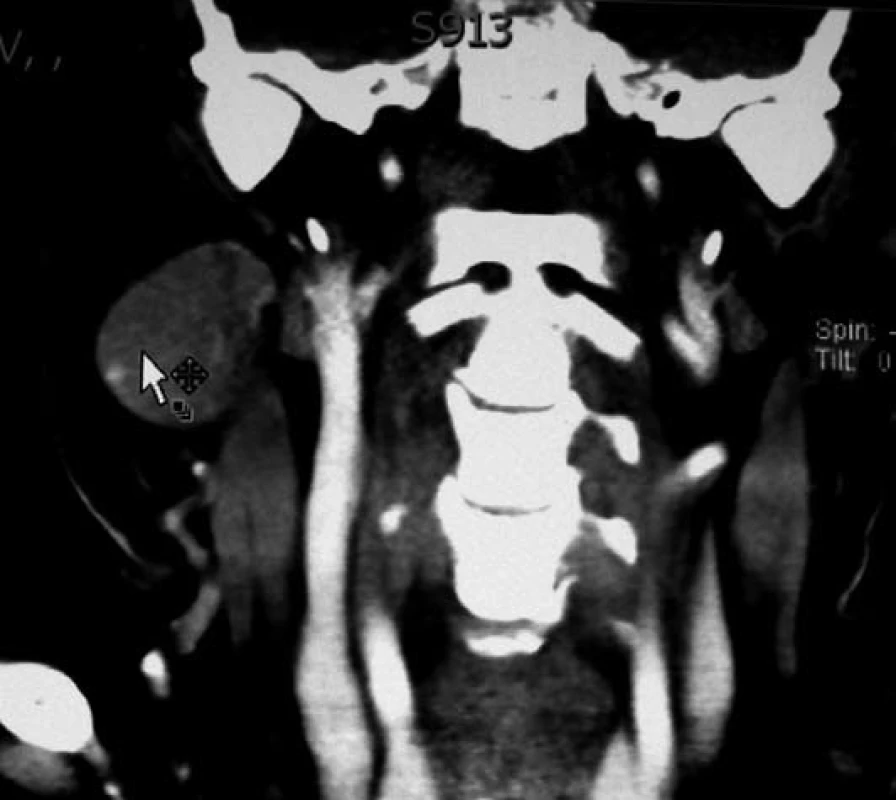 CT vyšetření s intravazálním kontrastem prokázalo tumor velikosti švestky pod pravým čelistním
úhlem