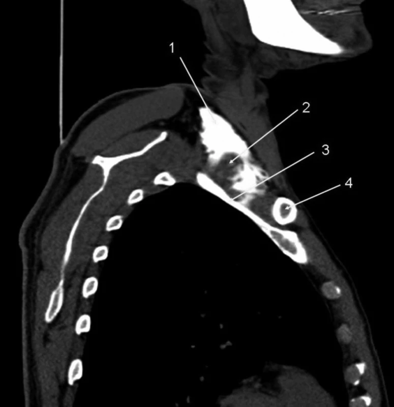 Interskalenická blokáda, 20 ml kontrastní látky
Parasagitální řez v oblasti klíční kosti, kontrastní náplň v prostoru skalenické fascie. Nad prvním žebrem patrná klíční kost, oba m. scaleni. Relativně široký interskalenický prostor a hromadění kontrastu nad klíčkem v prostoru s nízkou rezistencí.
Vysvětlivky: 1 – náplň skalenické fascie v místě nízké rezistence; 2 – m. scalenus med.; 3 – klíční kost; 4 – první žebro