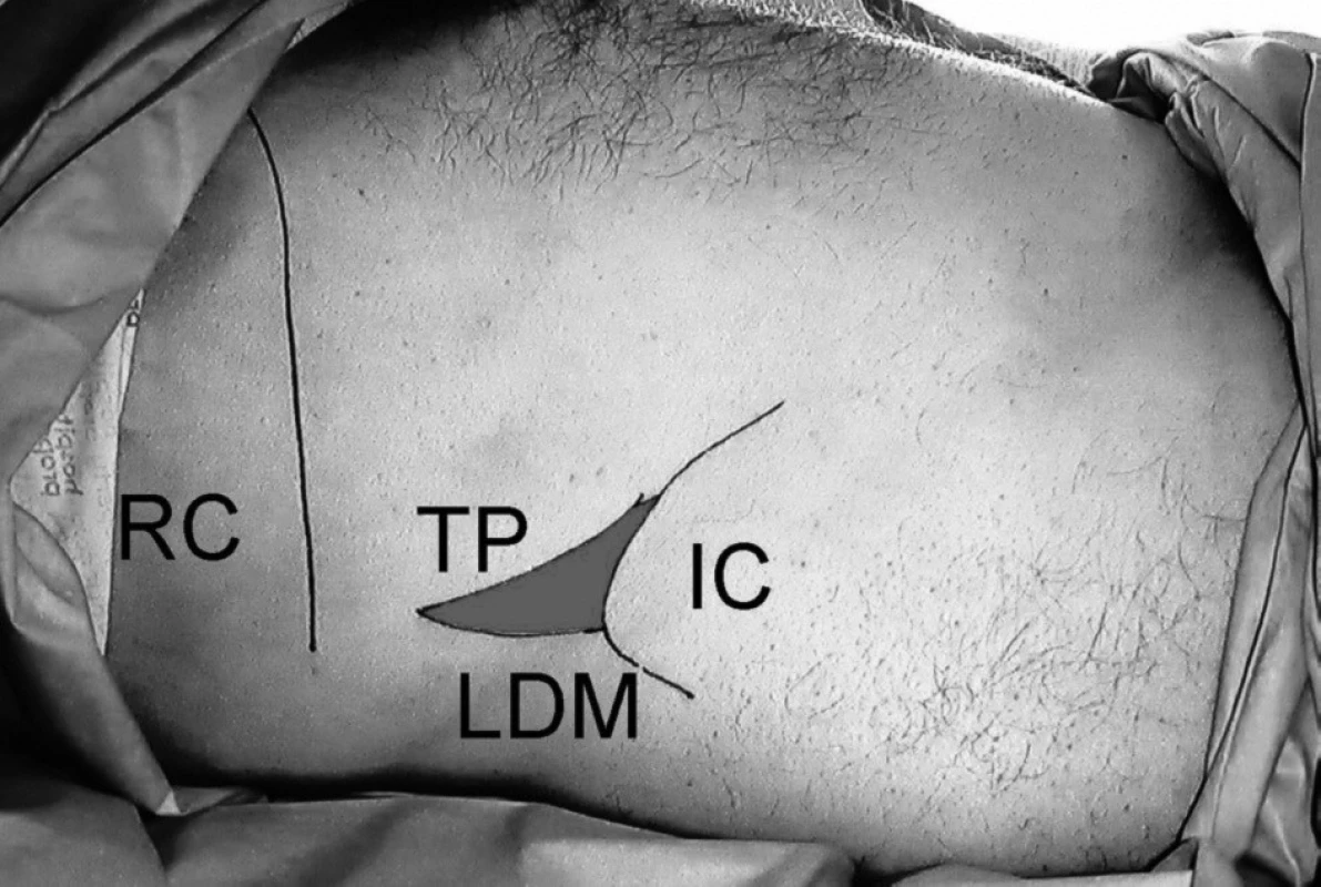 Anatomical landmarks for transversus abdominis plane
block
